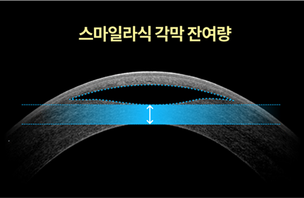 스마일라식 각막 잔여량을 나타낸 이미지 
