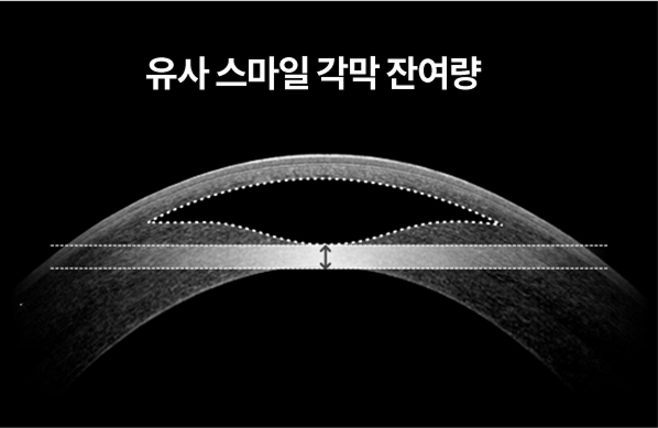 유사 스마일 각막 잔여량을 나타낸 이미지