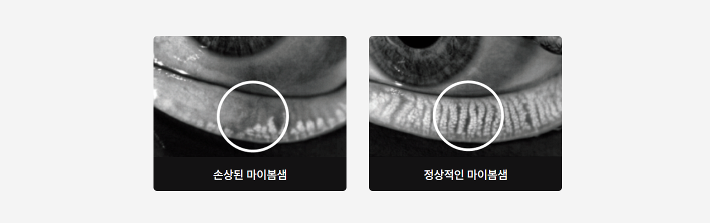 안구건조증 원인 및 마이봄샘 구조 안내