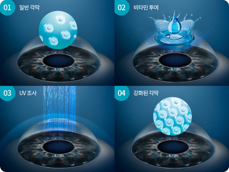 각막강화술 리보플라빈 점안 및 UV-A 조사 과정의 원리와 단계