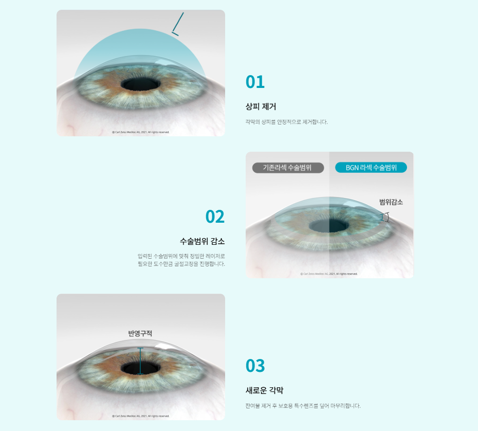 [정밀 검사부터 보호 렌즈 착용까지의 5단계 과정을 나타낸 인포그래픽]