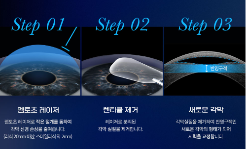 K5M 장비를 이용한 정밀 각막 두께 측정 및 분석 화면