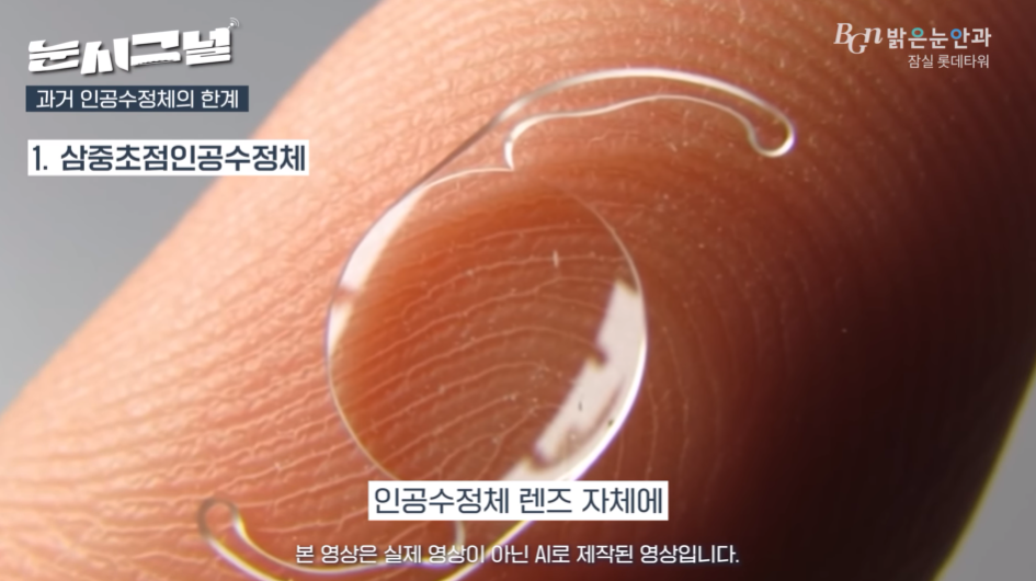 내장 수술용 단초점 및 다초점 렌즈의 장단점과 비급여 비용 차이 비교표