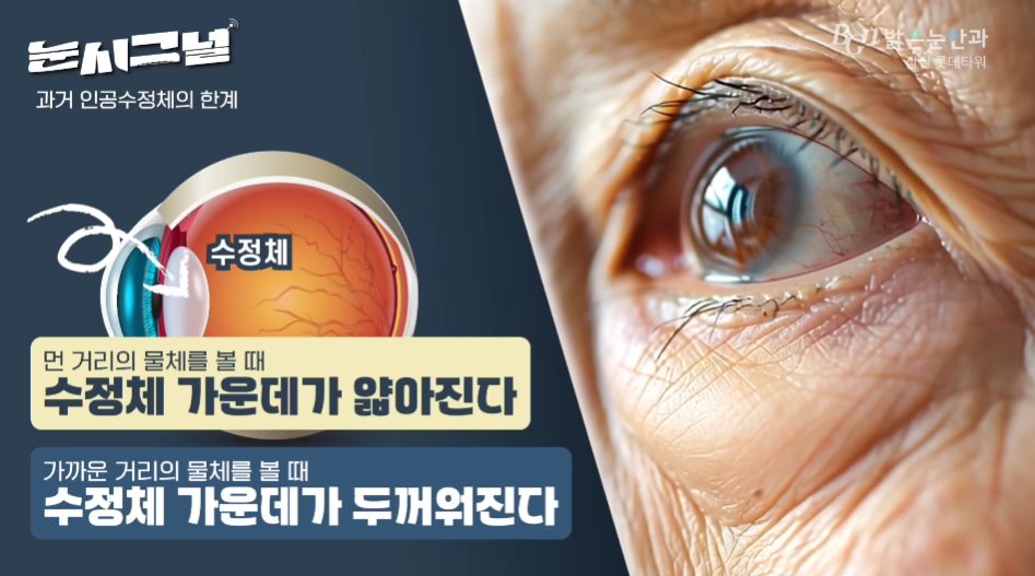 자에게 인공수정체 종류와 수술 계획을 설명하는 전문적인 의료진의 모습