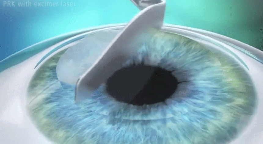 라섹 수술 후 각막 상피가 재생되는 원리와 정밀 검사 과정을 설명하는 이미지