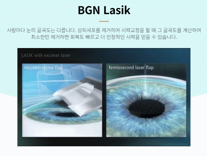 라식수술, 기본원리 인포그래픽