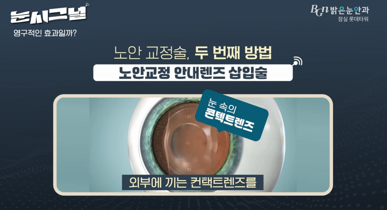 인공수정체 삽입술 이미지