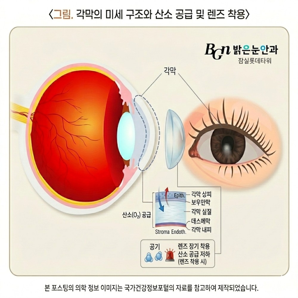 컬러렌즈의 낮은 산소 투과율과 각막 자극 위험성 설명