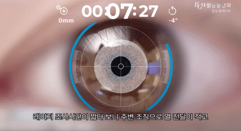 일반 시력과 스마일프로 수술 후 야간 도로 주행 시 불빛 번짐 현상이 현격히 줄어든 시야 비교 이미지