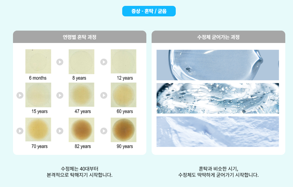 나이가 들면서 수정체 탄력이 떨어져 발생하는 노안의 진행 과정 단계별 요약