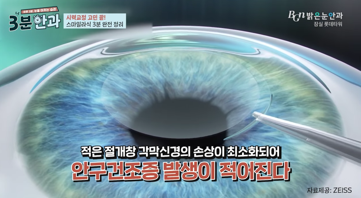 라식 수술 전 부작용 예방을 위한 눈물막 안정성 및 안구건조증 정밀 검사