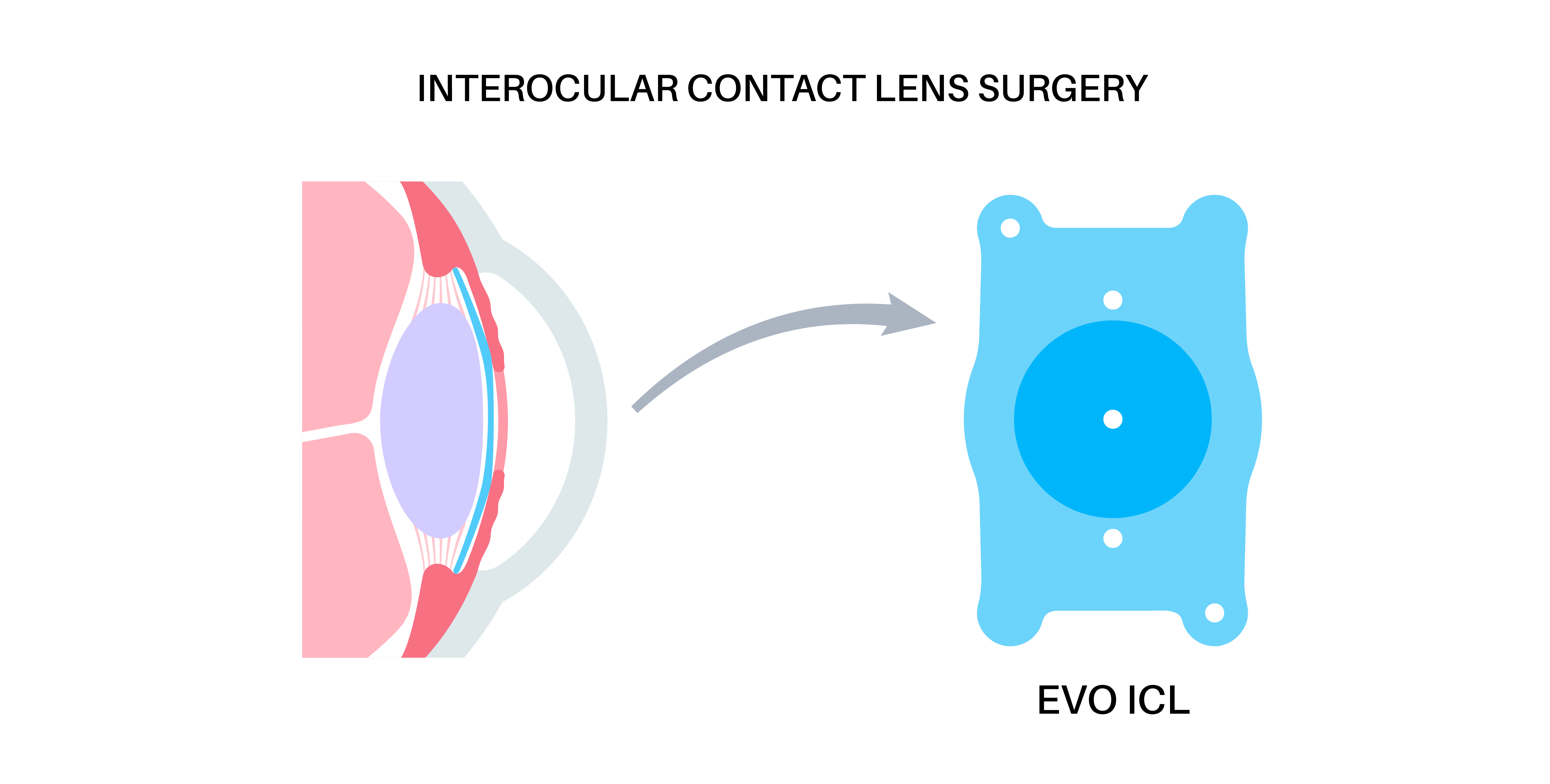 EVO+ 아쿠아 ICL 렌즈의 Centra FLOW(중앙 구멍) 확대 그래픽