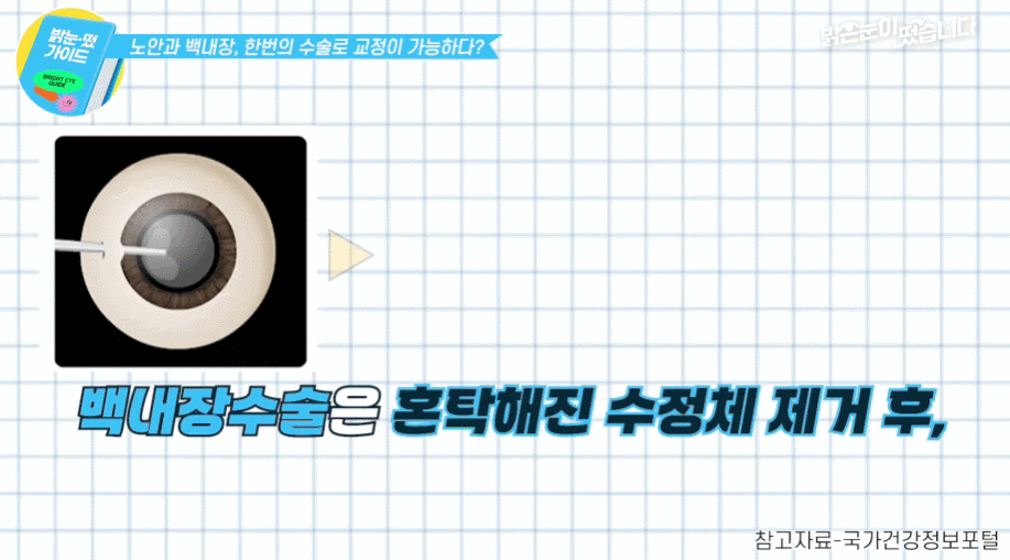 노안수술과 백내장수술의 원인, 목적, 시기, 렌즈 종류를 한눈에 볼 수 있는 요약 비교표