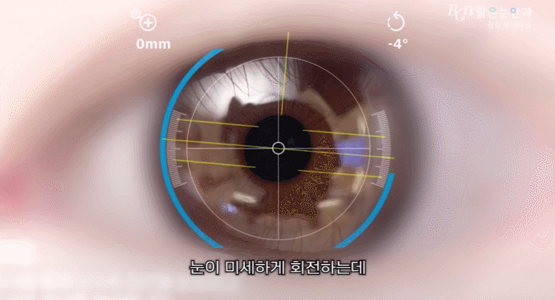 웨이브프론트 분석기 및 안구표면 분석기를 통한 정밀 검안 프로세스 이미지